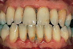 Periodontitis (advanced gum disease)